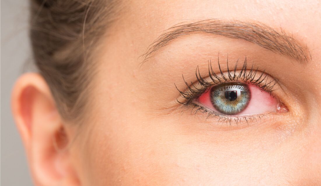 Ocular Surface Comfort