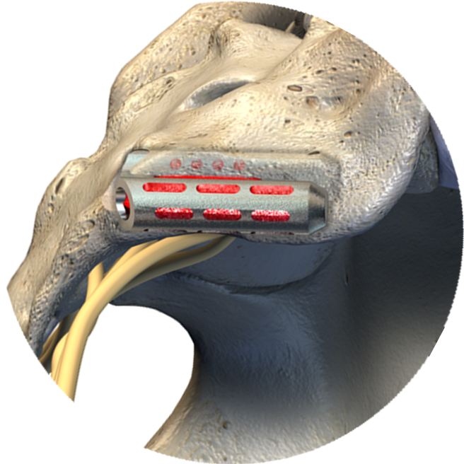 Si Joint Implant Placement