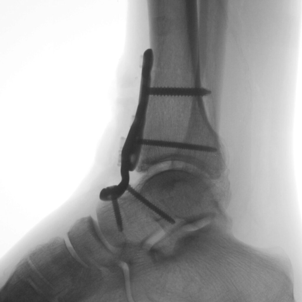 Ankle X-ray with screws