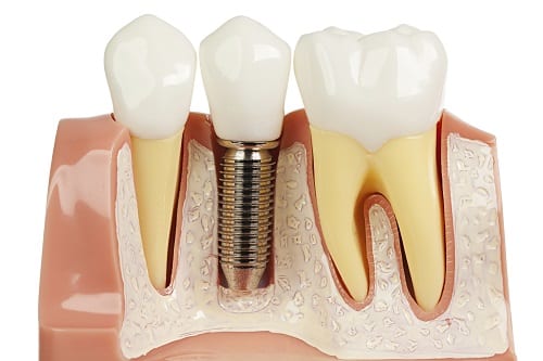 Implants cross-section