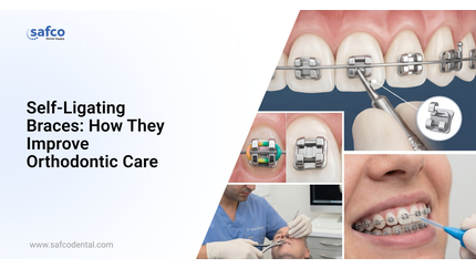Self-Ligating Braces