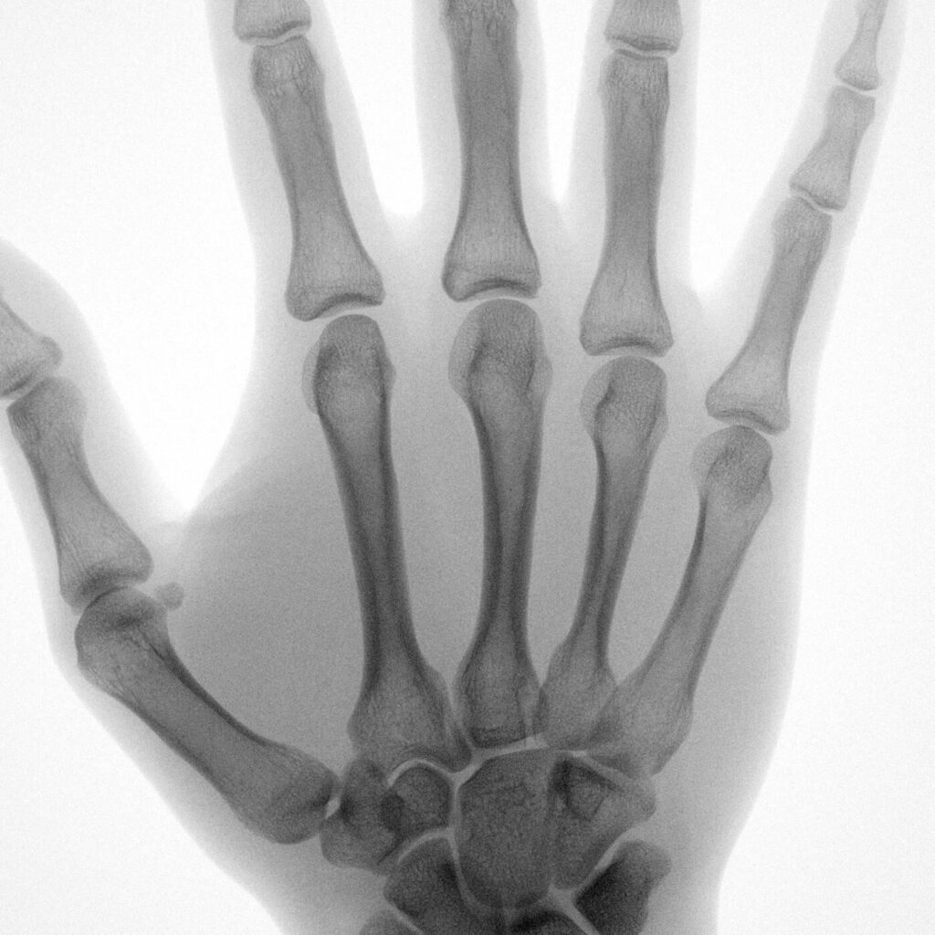 Hand x-ray
